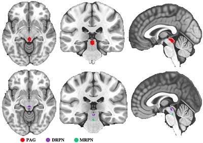 Acupuncture Enhances Dorsal Raphe Functional Connectivity in Knee Osteoarthritis With Chronic Pain